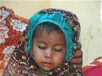 سندھ میں خسرے سے مزید چودہ بچے جاں بحق،ہلاکتوں کی تعداد196ہو گئی