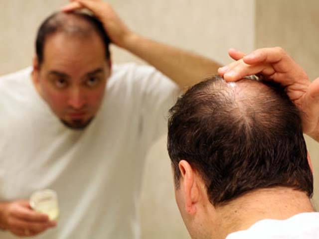 مردوں کے بال کیسے اور کیوں گرتے ہیں؟ وہ گنجے کیوں ہوجاتے ہیں؟ تمام باتیں جو آپ جاننا چاہتے ہیں