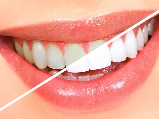 صرف3 منٹ میں دانتوں کو سفید اور چمکدار بنانے کیلئے آسان ترین قدرتی نسخہ