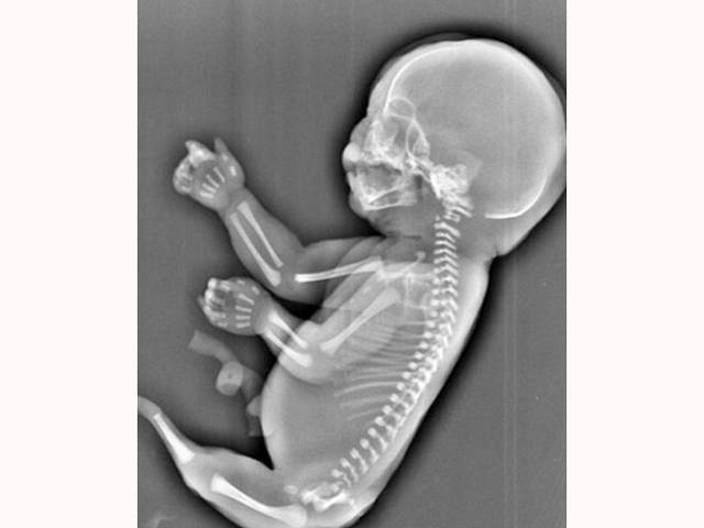 6 ماہ کی حاملہ خاتون کے پیٹ کا ڈاکٹر نے سکین کیا تو بچے کی ایسی تصویر سامنے آگئی کہ دیکھ کر ماں کی بھی چیخیں نکل گئیں، پیٹ میں ہی اسے مار ڈالا کیونکہ۔۔۔