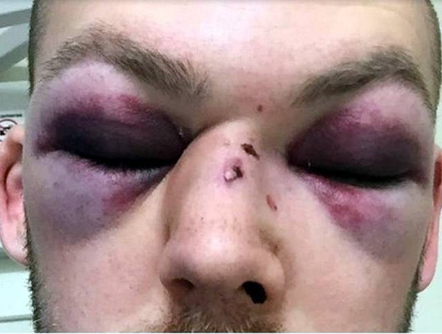 برطانوی کرکٹر کے چہرے پر گیند لگنے کے باعث 15 جگہ سے ہڈی ٹوٹ گئی، مکمل بحالی کیلئے متعدد آپریشنز درکار 