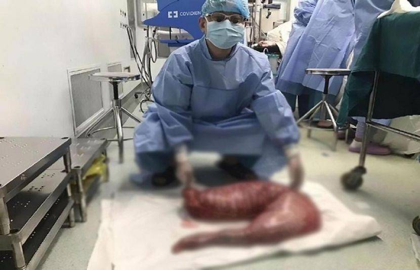 چینی شخص کی سرجری،30انچ لمبی آنت نکال لی گئی