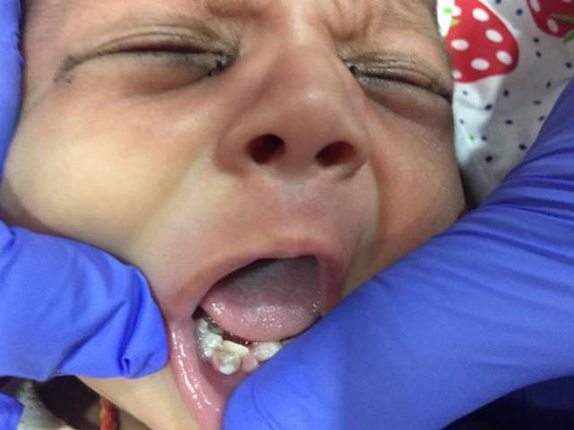 7 ماہ کی حاملہ خاتون نے بچے کو جنم دے دیا، پیدائش کے بعد ڈاکٹر نے چیک اپ کیلئے بچے کا منہ کھولا تو اندر ایسی چیز نظر آگئی کہ اپنا منہ بھی حیرت کے مارے کھلا کا کھلا رہ گیا، یہ منظر پہلے نہ دیکھا تھا کہ۔۔۔