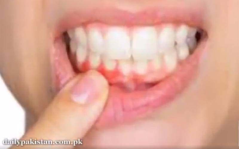 اگر آپ دانتوں کے  شدید درد  سے بچنا چاہتے ہیں تو یہ عام سا گھریلو نسخہ ضرور استعمال کریں 