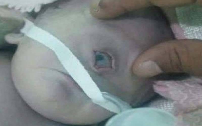 یمن میں ایک آنکھ والے بچے کی پیدائش