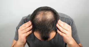 گنجے پن کو دور کرنے کیلئے کیسٹر آئل کو استعمال کرنے کا صحیح طریقہ کیا ہے؟