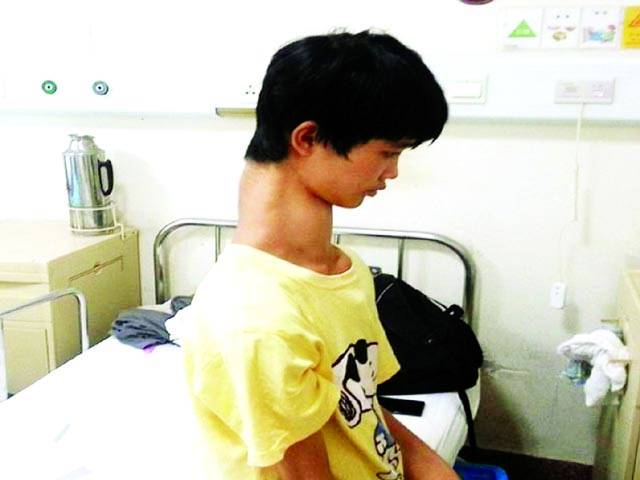 پندرہ سالہ لڑکے کولمبی گردن سے نجات پانے کے لئے سرجری تجویز