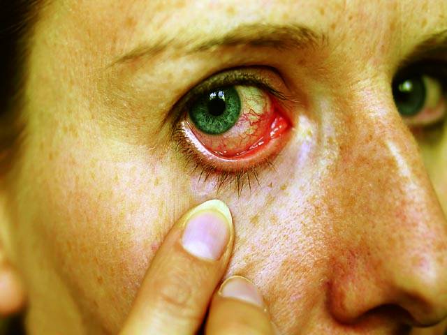 آنکھوں کو خطرناک بیماری سے بچانے کے لئے کنٹیکٹ لینز کا استعمال احتیاط سے